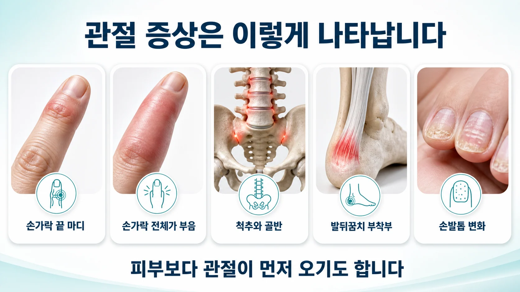 건선관절염의 다섯 가지 관절 증상 형태를 정리한 도식