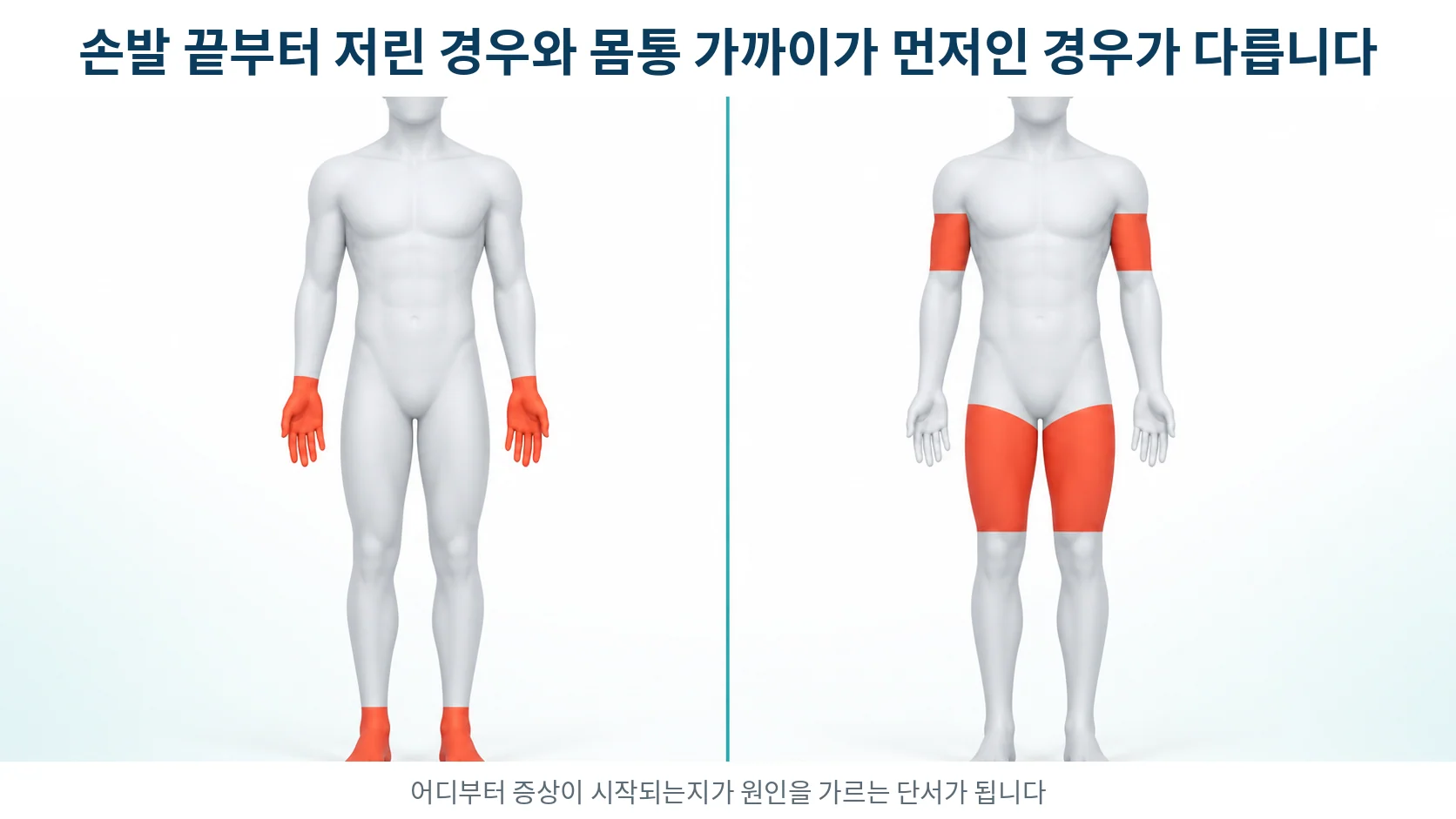 인체 실루엣 두 개에서 한쪽은 손발 끝만, 다른 쪽은 허벅지와 몸통 가까운 쪽까지 표시된 증상 분포 비교 그림