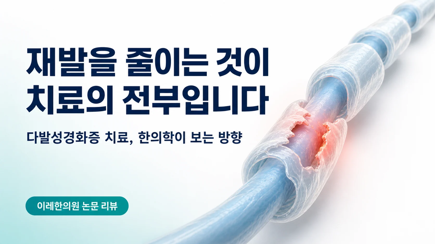 재발을 줄이는 것이 치료의 전부라는 주제의 다발성경화증 글 표지 이미지