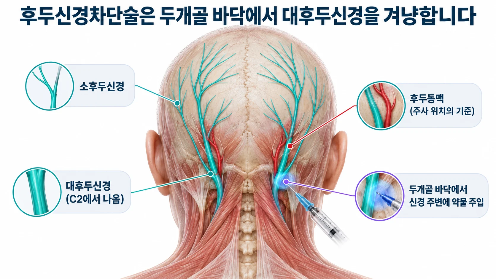 뒤통수에서 대후두신경과 소후두신경, 후두동맥의 위치와 두개골 바닥의 주사 지점을 표시한 3D 그림