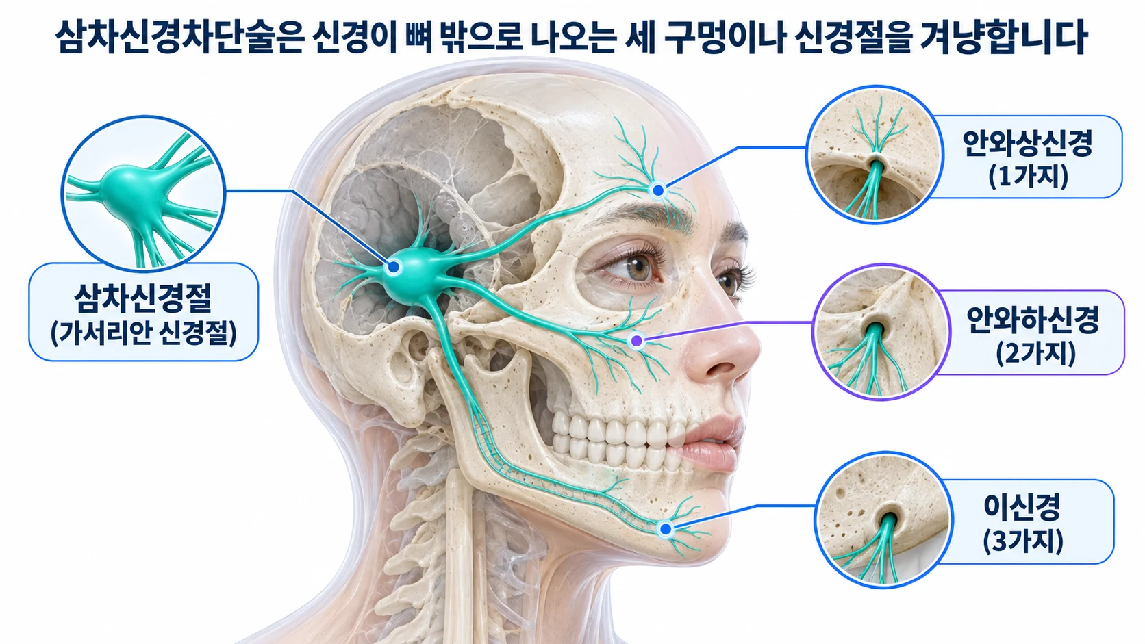 삼차신경절에서 나온 세 가지가 안와상공·안와하공·이공으로 나오는 위치를 표시한 3D 그림