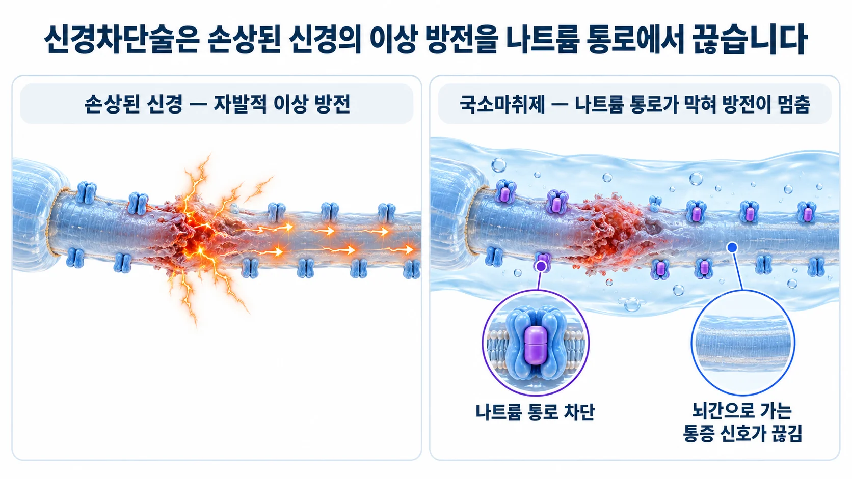 손상된 신경의 자발적 이상 방전과 국소마취제가 나트륨 통로를 막아 방전이 멈춘 상태를 비교한 3D 그림