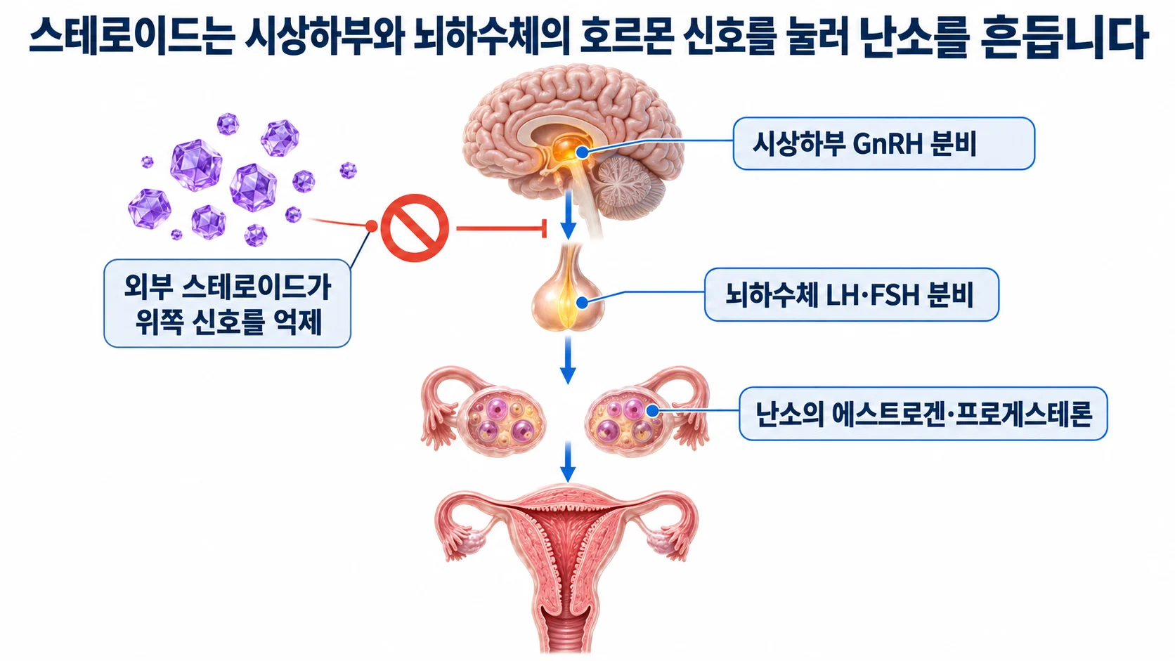 외부 스테로이드가 시상하부와 뇌하수체의 신호를 억제해 난소와 자궁내막에 영향을 미치는 호르몬 축을 보여 주는 3D 도식