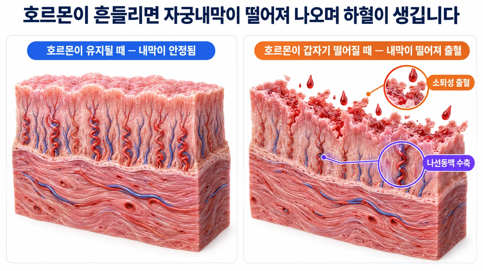호르몬이 유지될 때와 갑자기 떨어질 때 자궁내막이 떨어져 나오는 과정을 비교한 3D 그림