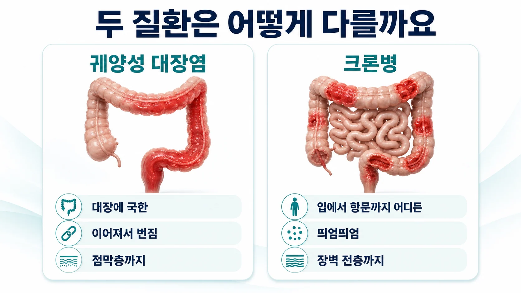 궤양성 대장염과 크론병의 차이를 비교한 도식
