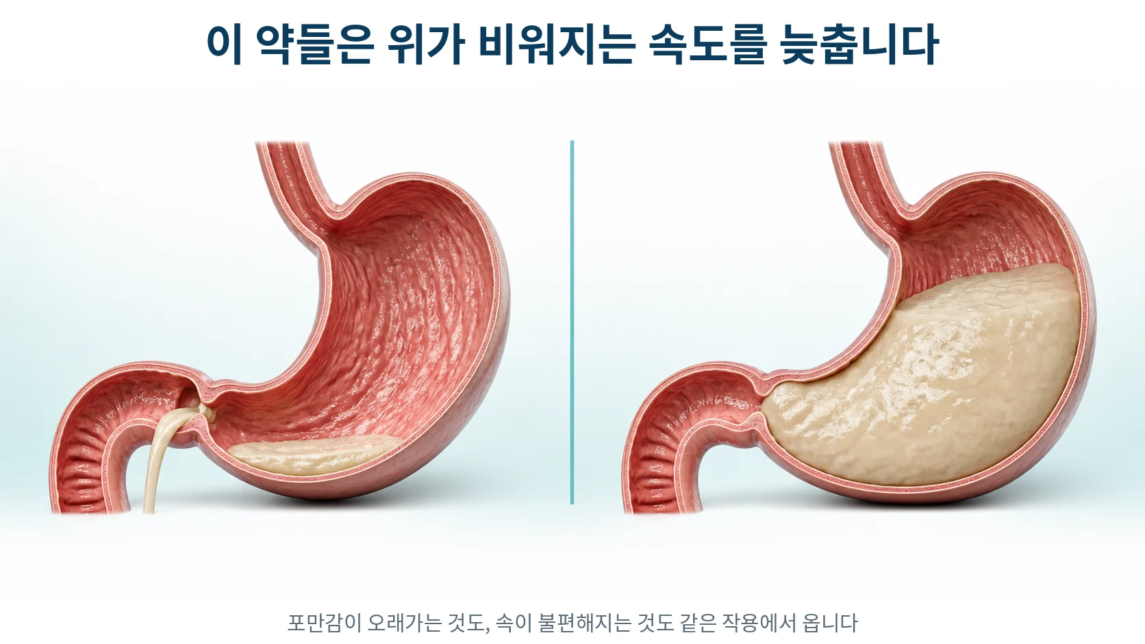 위에서 음식물이 빠르게 내려가는 정상 상태와 천천히 남아 있는 상태를 나란히 비교한 단면 그림