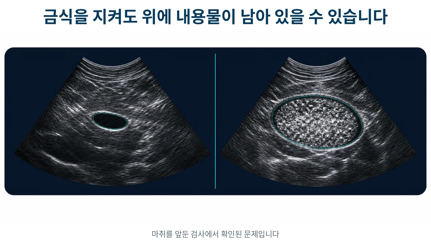 금식 후에도 위에 내용물이 남아 있는 상태와 완전히 비워진 상태를 초음파 화면처럼 비교해 보여 주는 그림