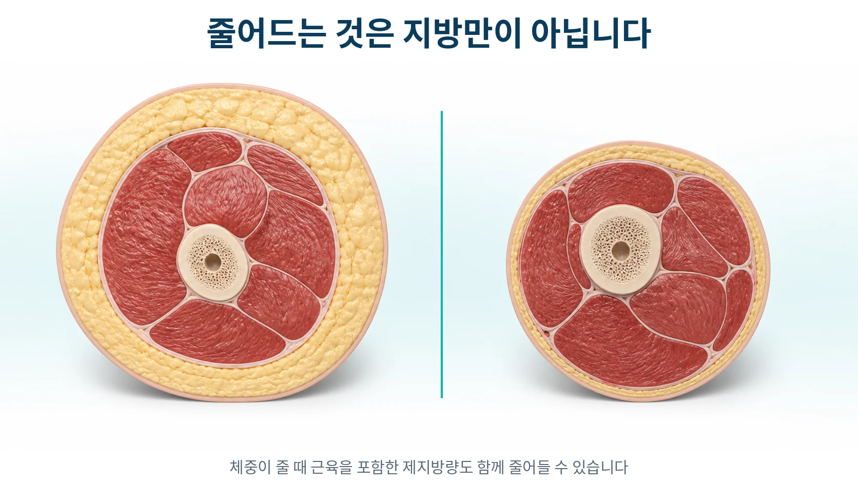 허벅지 단면에서 지방층과 근육층의 두께가 함께 줄어드는 변화를 두 단계로 비교한 그림