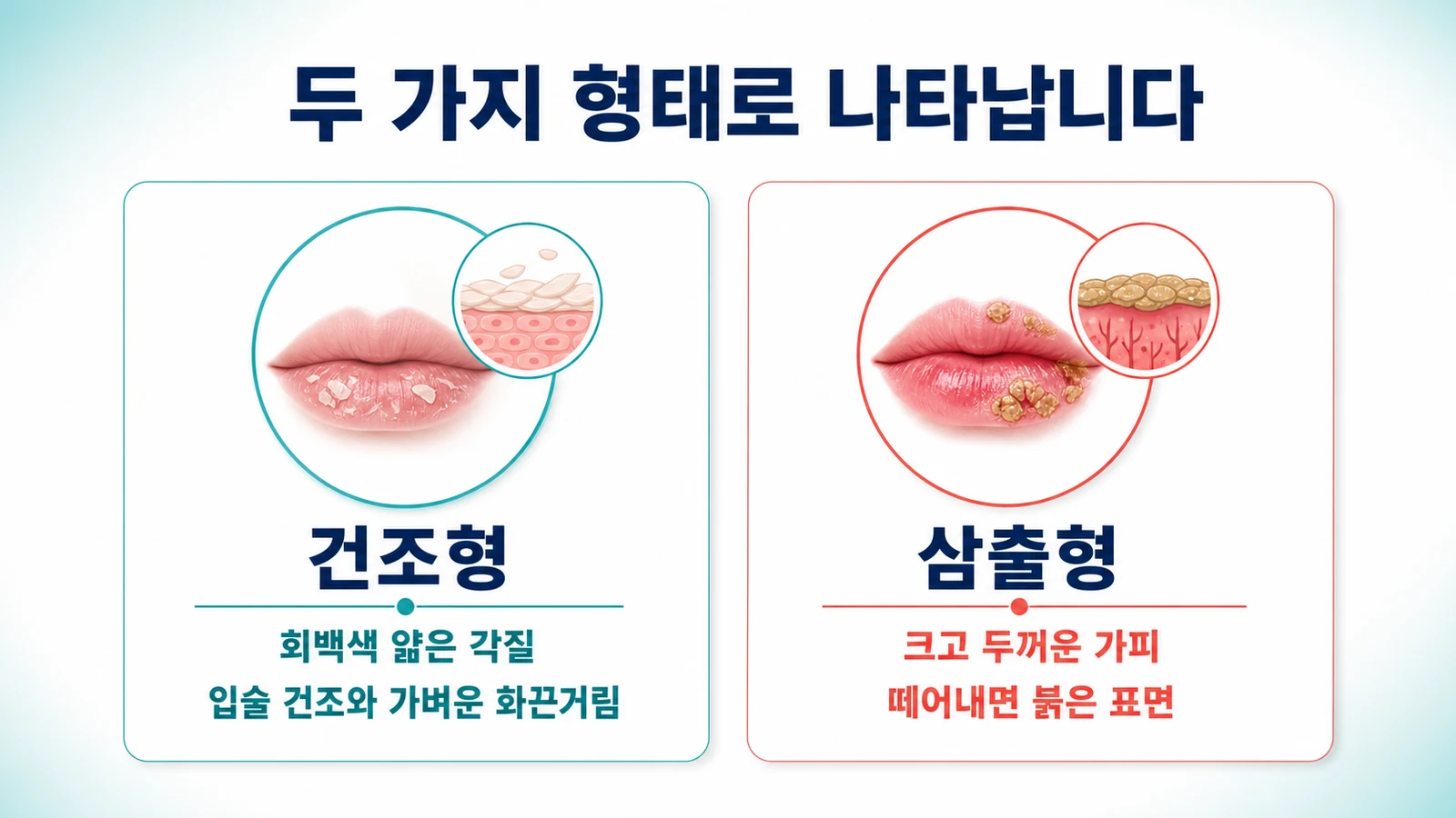 건조형과 삼출형 두 가지 형태의 박탈성 구순염을 비교한 그림