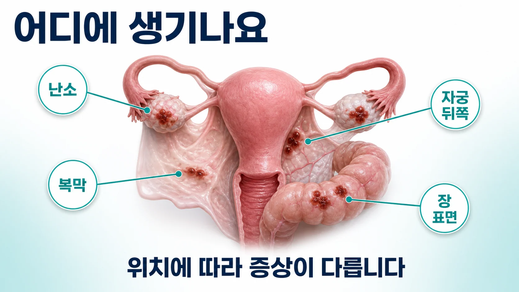 병변이 생기는 자리를 정리한 도식