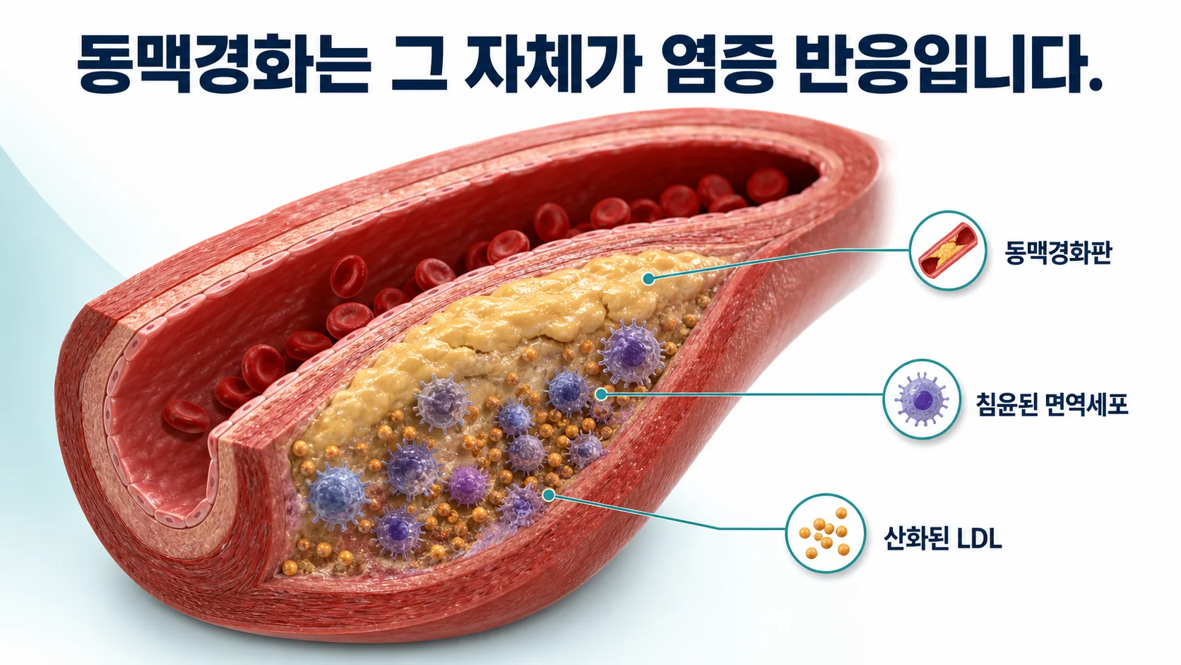 만성 염증이 이어지는 자가면역질환에서 혈관에 동맥경화가 더 잘 생기는 구조를 나타낸 그림