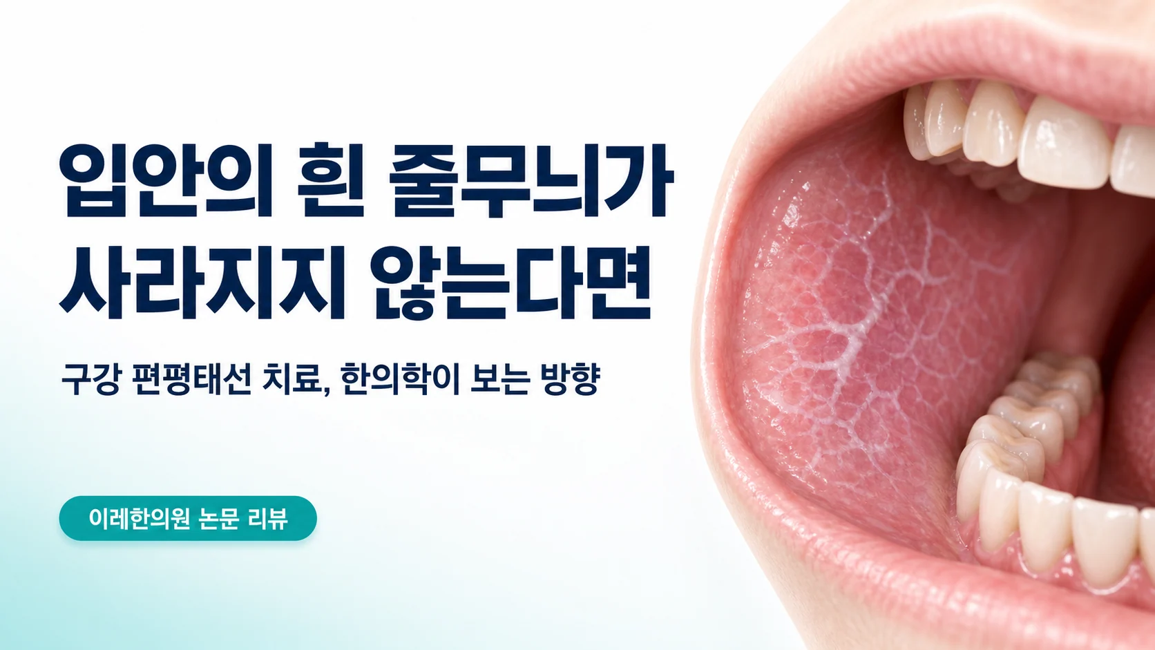 구강 편평태선 — 스테로이드를 줄여도 유지되어야 합니다