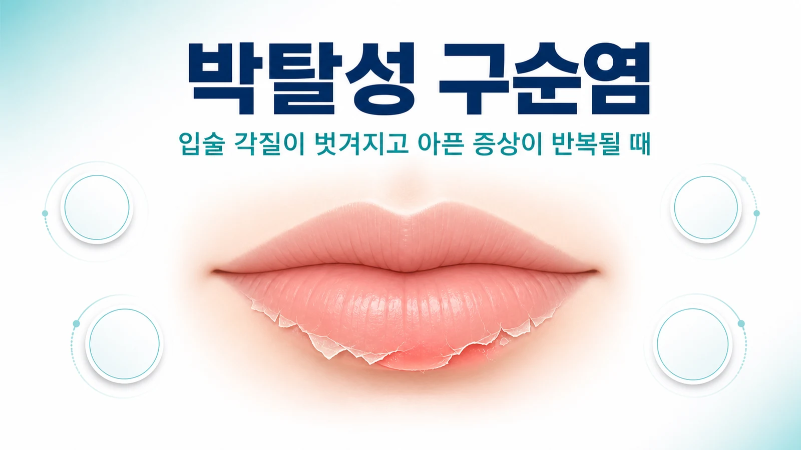 박탈성 구순염 — 입술 각질이 벗겨지고 아픈 증상이 반복될 때