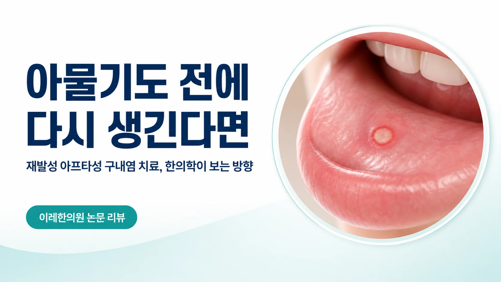 재발성 아프타성 구내염 — 재발 간격을 늘리는 것이 목표입니다