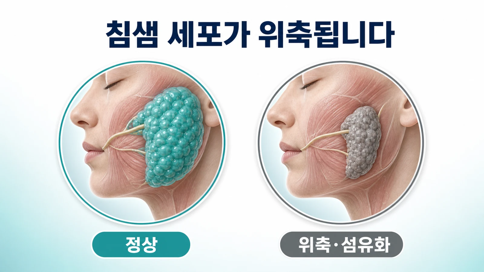 침샘 세포가 위축되고 섬유화됩니다