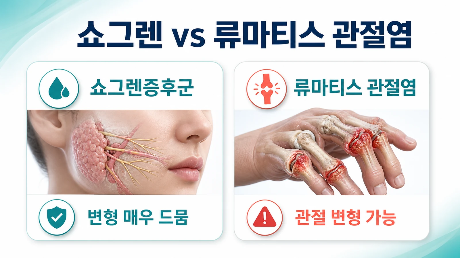 쇼그렌 관절통과 류마티스 관절염의 차이