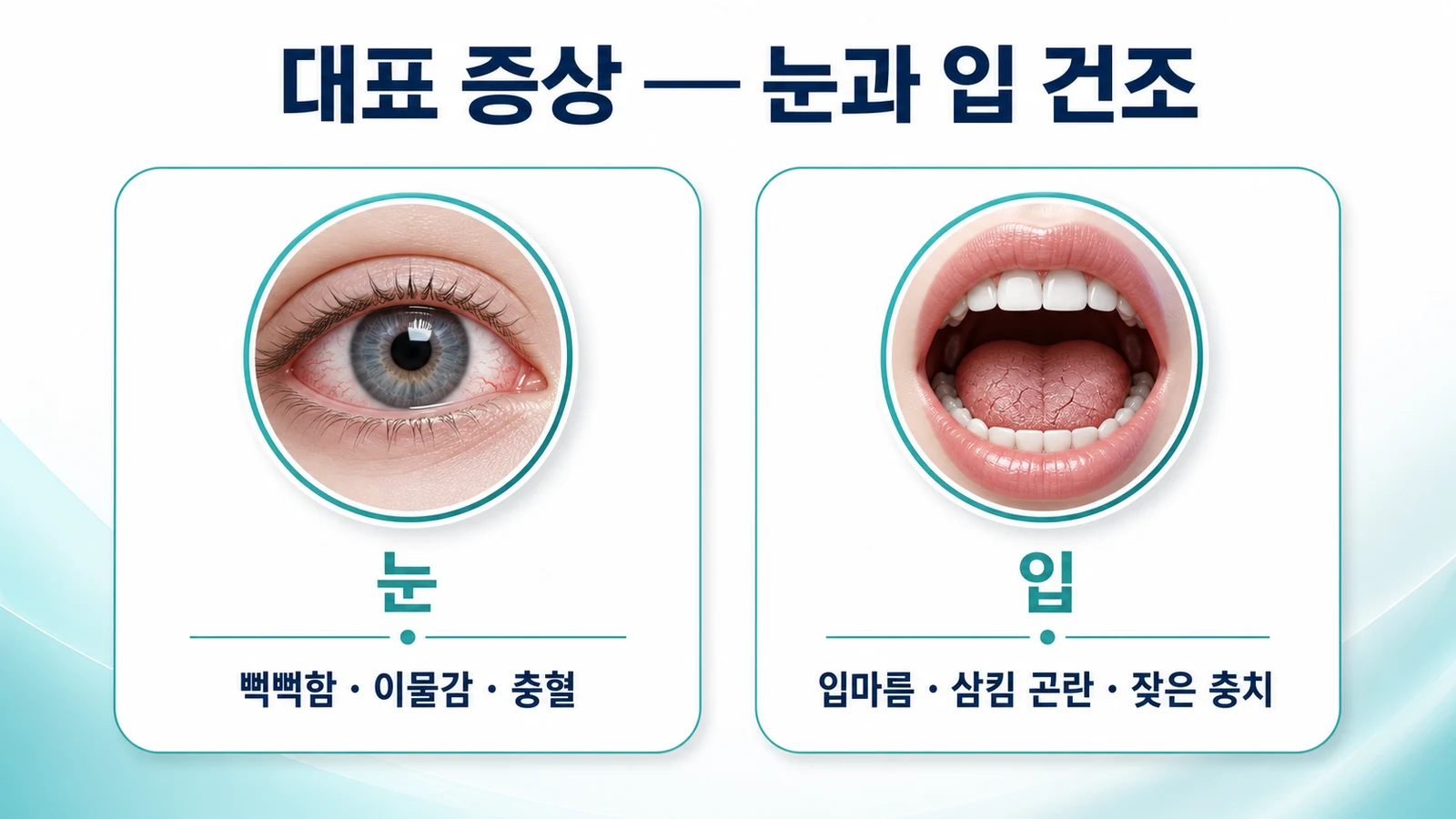 쇼그렌증후군 대표 증상 — 눈과 입 건조