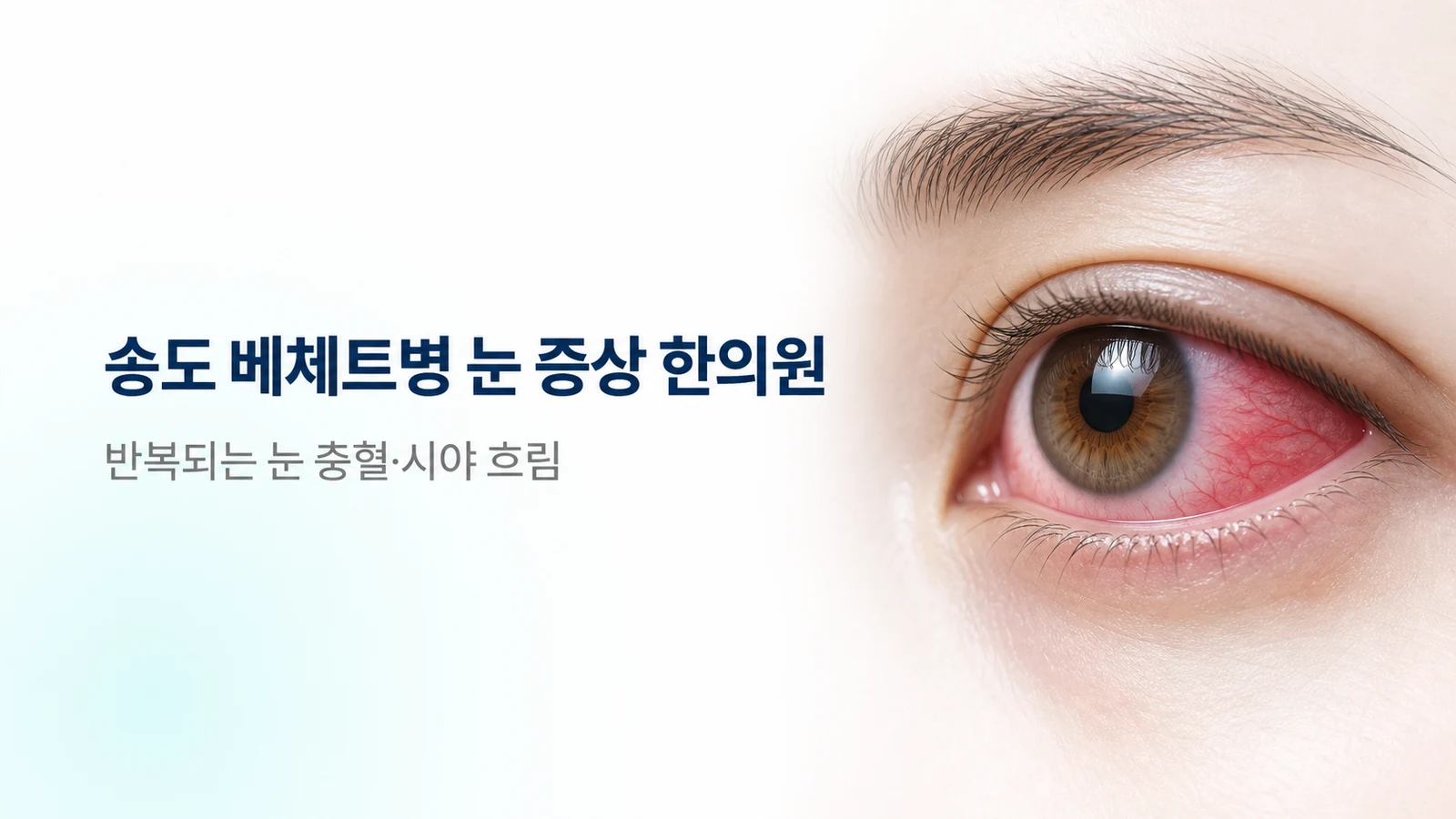 베체트병 눈 증상 — 반복되는 눈 충혈·시야 흐림