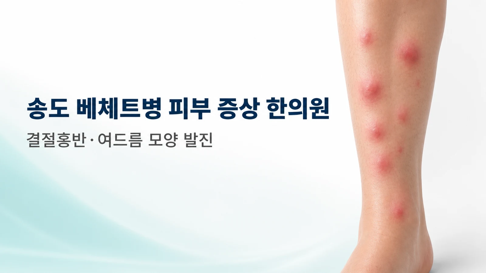 베체트병 피부 증상 — 결절홍반·여드름 모양 발진