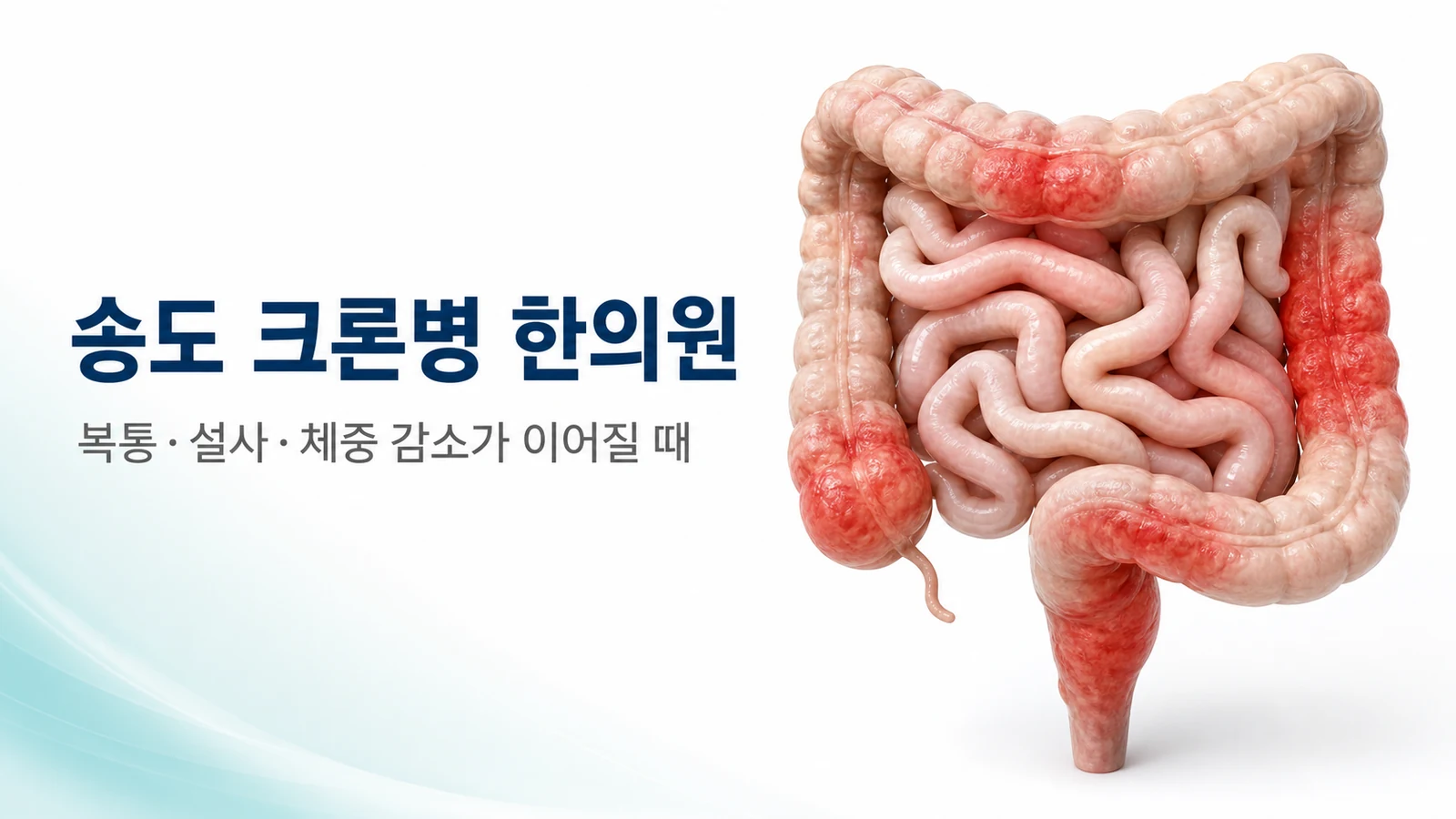 크론병 — 복통·설사·체중 감소가 이어질 때 한방 관리