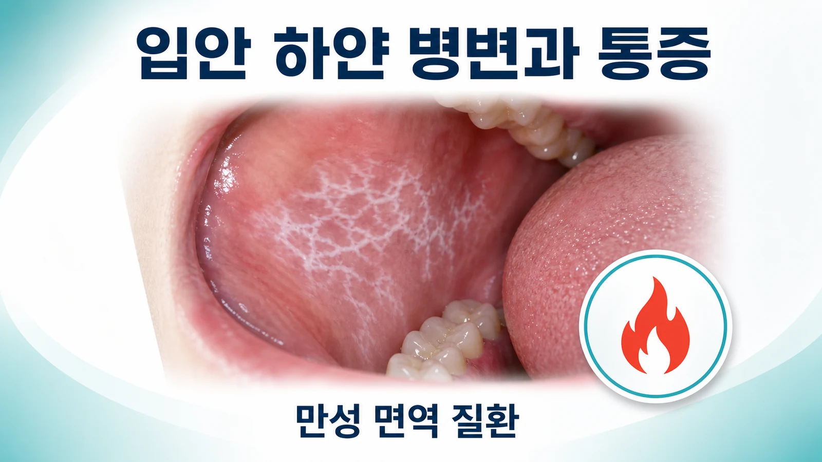 입안 하얀 병변과 통증