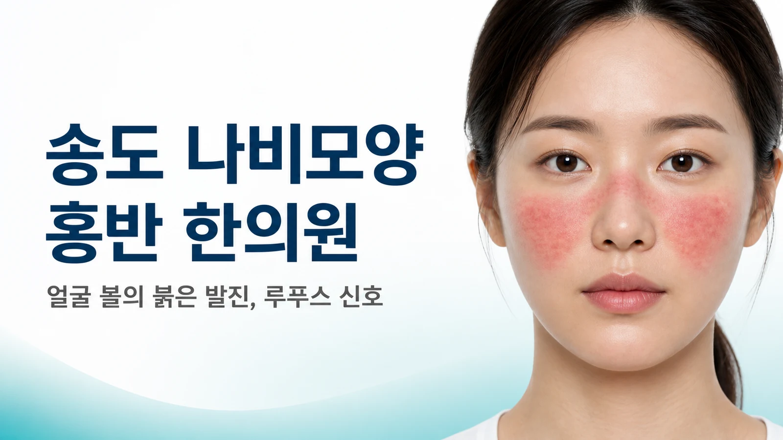 나비모양 홍반 — 얼굴 볼의 붉은 발진, 루푸스 신호