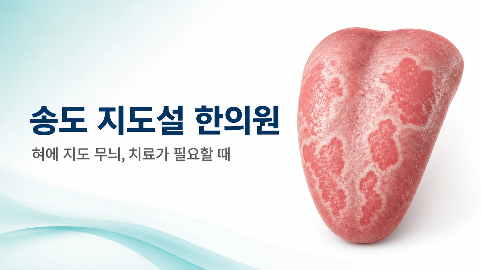 지도설 — 혀에 지도 무늬가 생겼을 때 치료가 필요한 경우