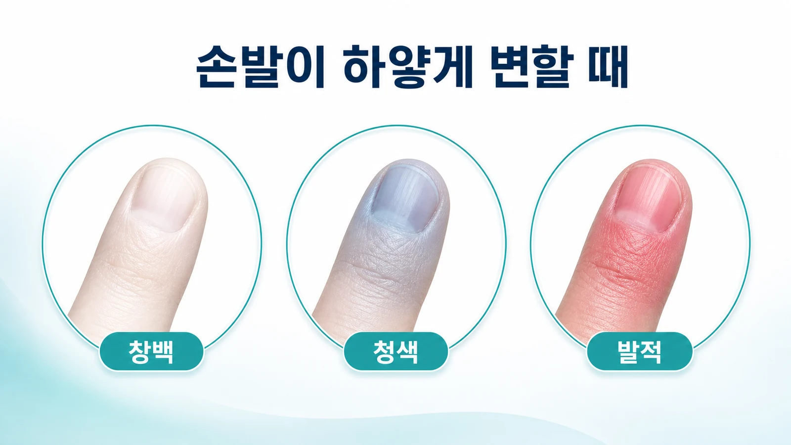 손발이 하얗게 변할 때