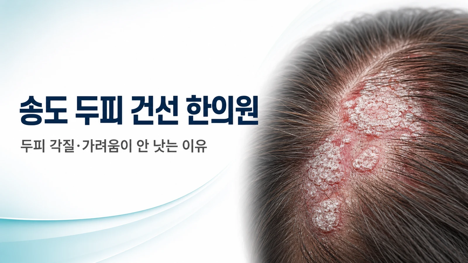 두피 건선 — 두피 각질·가려움이 안 낫는 이유