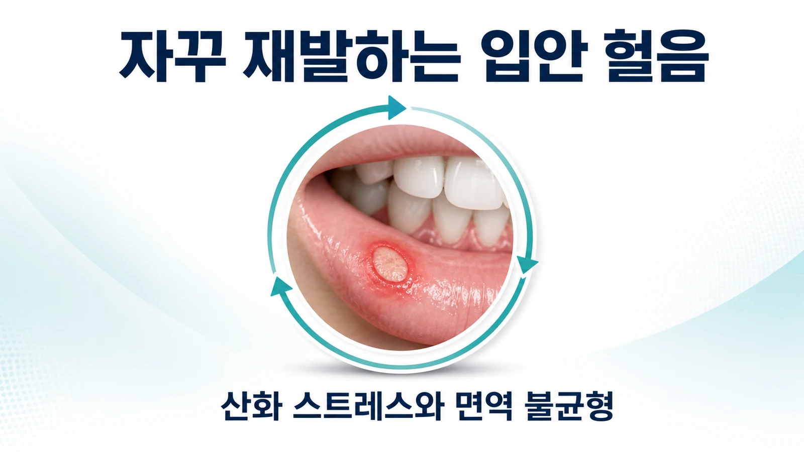자꾸 재발하는 입안 헐음