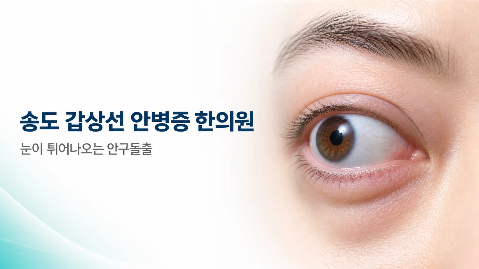 갑상선 안병증 — 눈이 튀어나오는 안구돌출, 한방 관리