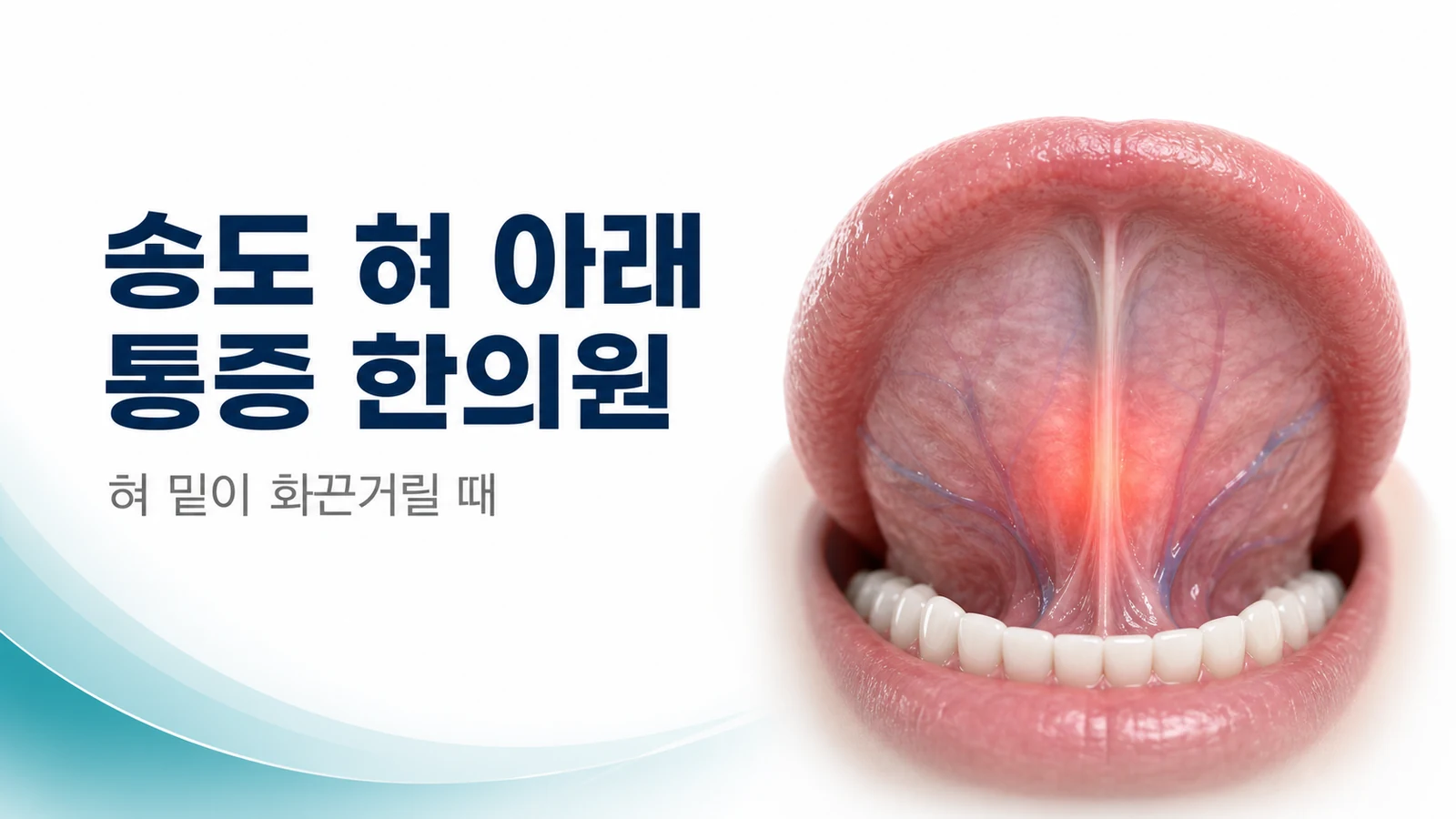 혀 아래 통증 — 혀 밑이 화끈거리고 스트레스에 심해질 때 치료