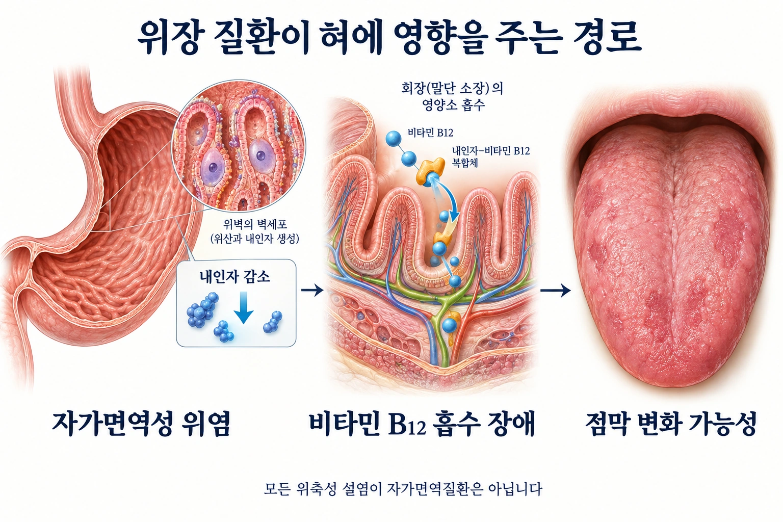 위축성 위염의 내인자 감소와 비타민 B12 흡수 장애가 혀 점막 변화에 연결될 수 있는 경로