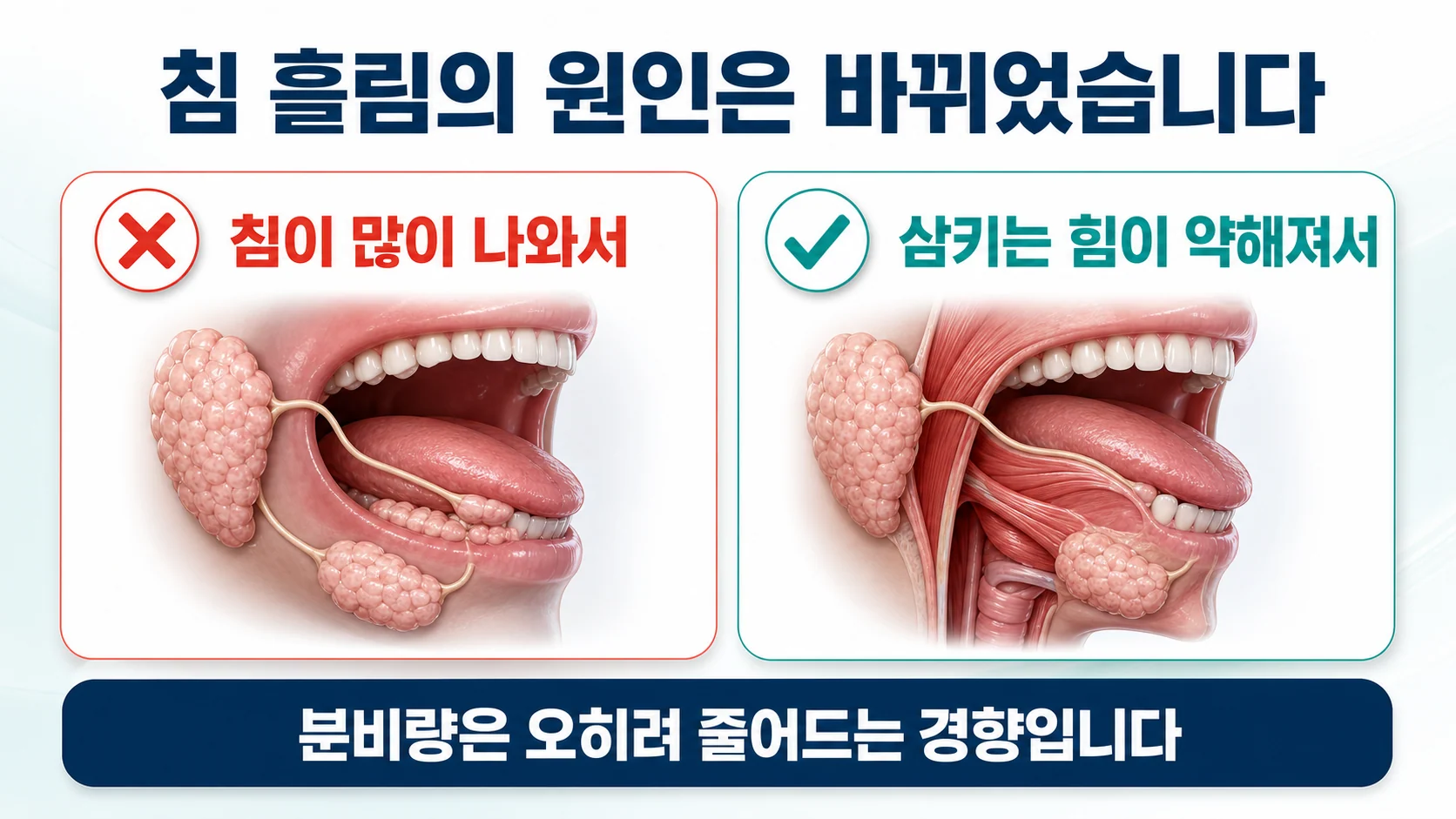 파킨슨병 침흘림, 삼키는 횟수가 줄어들 때